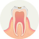 虫歯イメージ1