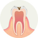 虫歯イメージ2