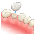 クラウンを被せる