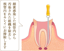 細菌感染した根管内から汚染された組織を撤去し根管内をきれいにお掃除します