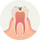 虫歯が神経に近くなり、冷たいものがしみます